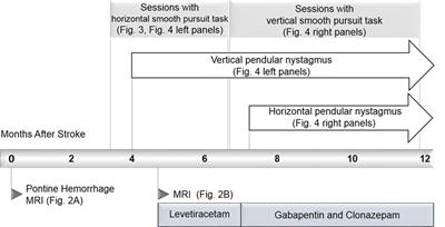 Longitudinal Quantification of Eye-Movement Impairments after Pontine Hemorrhage